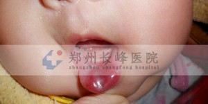 郑州长峰医院是如何治疗婴幼儿血管瘤的？