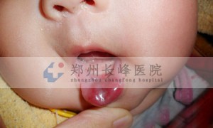 郑州长峰医院是如何治疗婴幼儿血管瘤的？
